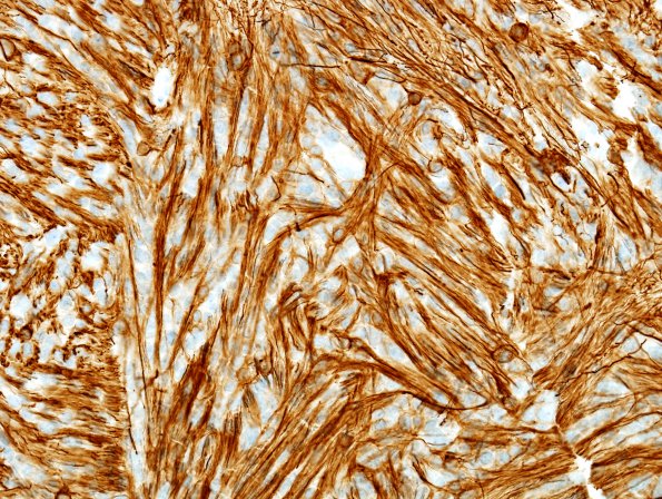 5B3 Ependymoma, tanycytic (Case 5) GFAP 1