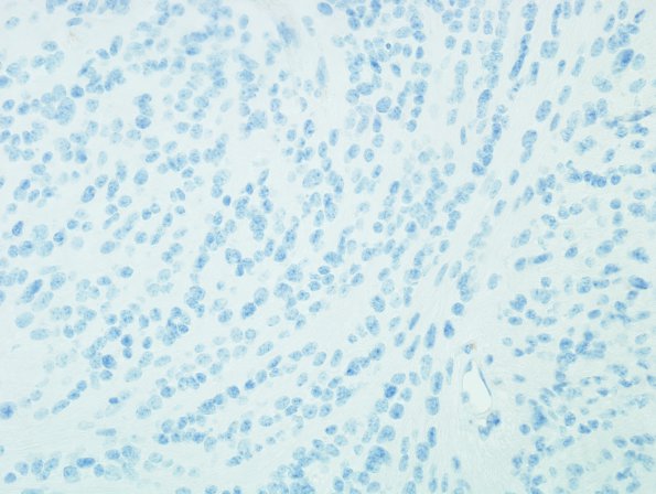 5C Ependymoma, tanycytic (Case 5) EMA 1