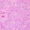 6A1 Ependymoma, tanycytic (Case 6) H&E 5