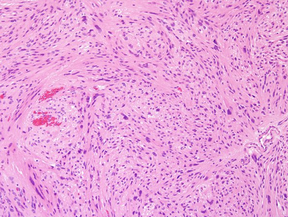 6A1 Ependymoma, tanycytic (Case 6) H&E 5