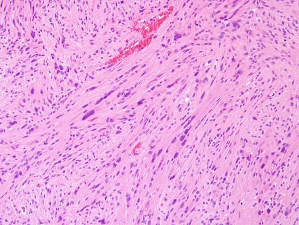 6A2 Ependymoma, tanycytic (Case 6) H&E 6