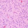 6A3 Ependymoma, tanycytic (Case 6) H&E 10.