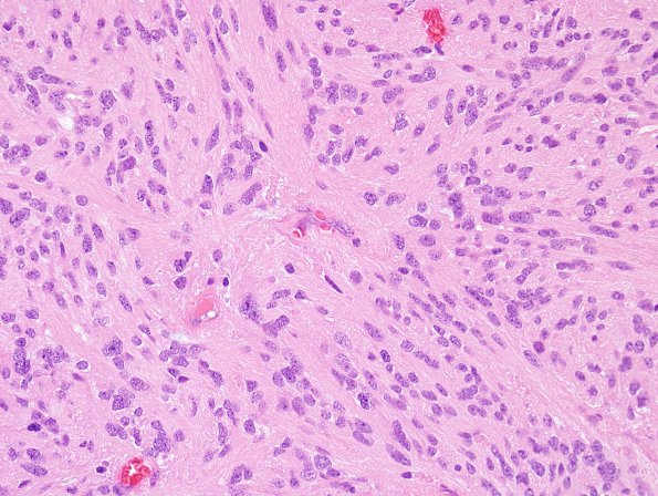 6A3 Ependymoma, tanycytic (Case 6) H&E 10.