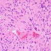 6A4 Ependymoma, tanycytic (Case 6) H&E 14