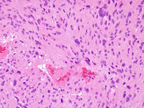 6A4 Ependymoma, tanycytic (Case 6) H&E 14