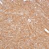 6B1 Ependymoma, tanycytic (Case 6) GFAP 4.