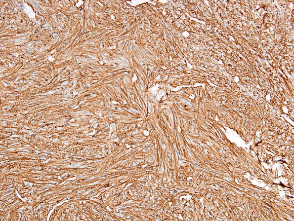 6B1 Ependymoma, tanycytic (Case 6) GFAP 4.