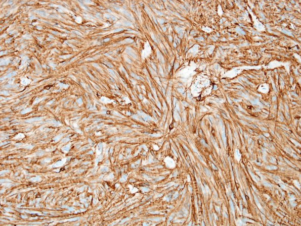 6B2 Ependymoma, tanycytic (Case 6) GFAP 3.