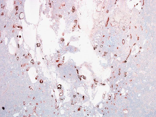 6C1 Ependymoma, tanycytic (Case 6) Coll IV 5