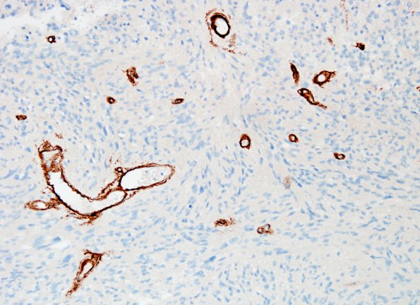 6C2 Ependymoma, tanycytic (Case 6) Coll IV 6