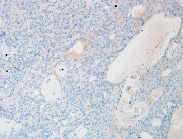 6D Ependymoma, tanycytic (Case 6) Ki67 3