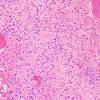 7B1 Ependymoma, (Case 7) H&E 4