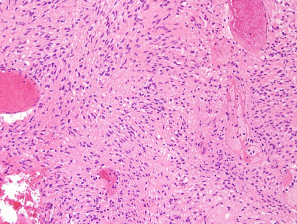 7B1 Ependymoma, (Case 7) H&E 4