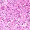 7B2 Ependymoma, (Case 7) H&E 20X 1.