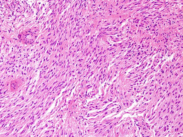 7B2 Ependymoma, (Case 7) H&E 20X 1.