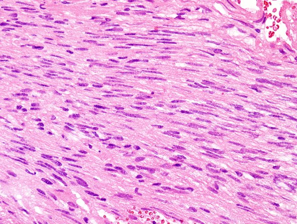 7B3 Ependymoma, (Case 7) H&E 40XA