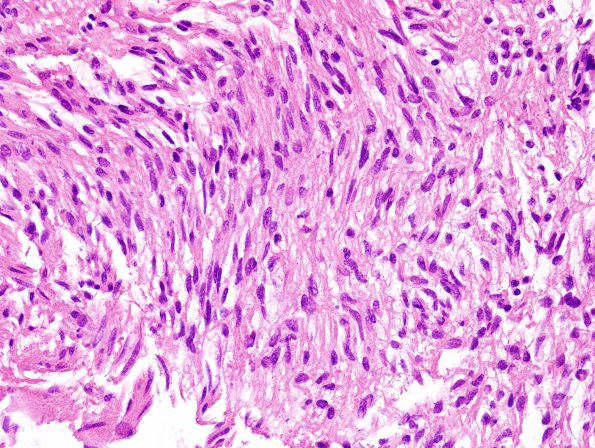 7B4 Ependymoma, (Case 7) H&E 1 40X