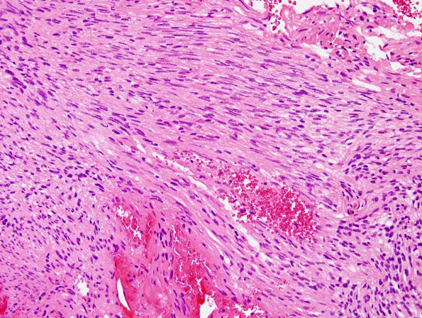 7B5 Ependymoma, (Case 7) H&E 20X 2.j