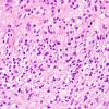 7B6 Ependymoma, (Case 7) H&E 1