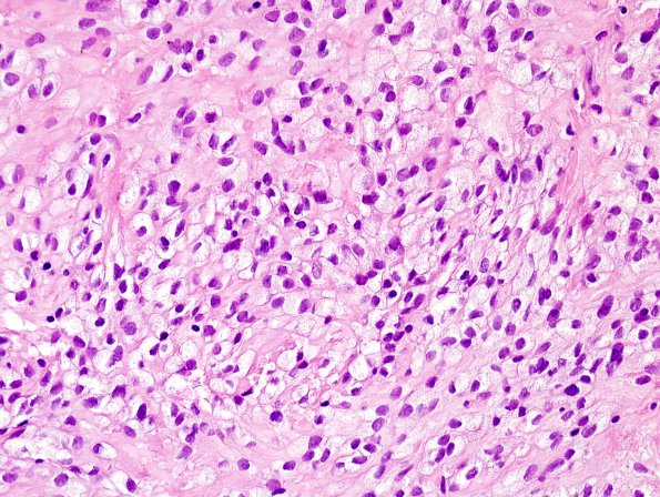 7B6 Ependymoma, (Case 7) H&E 1