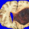 10A1 Glioblastoma (Case 10) 5