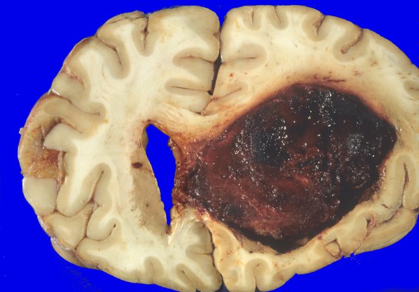 10A1 Glioblastoma (Case 10) 5