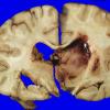 10A2 Glioblastoma (Case 31) 4