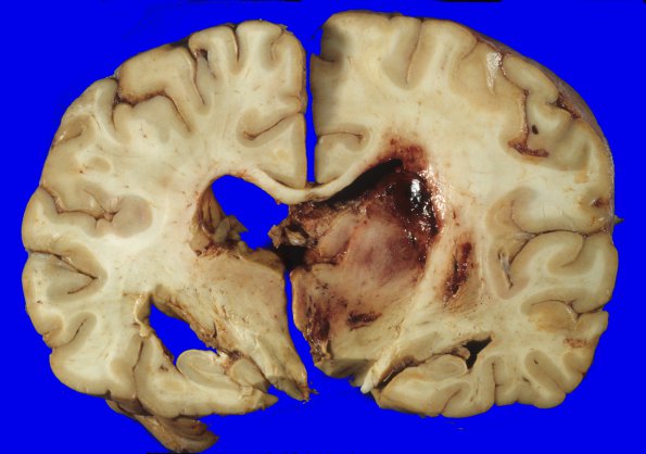 10A2 Glioblastoma (Case 31) 4