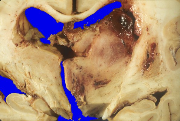 10A3 Glioblastoma (Case 31) 3