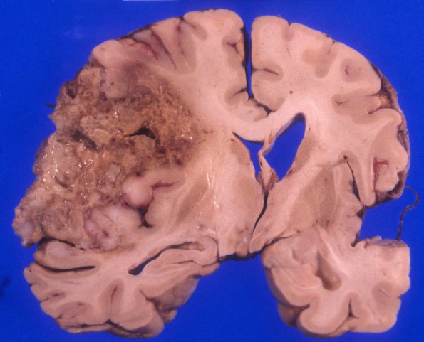 11A1 GBM (Case 11) 1