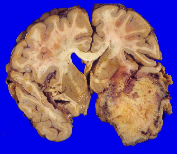 14A1 GBM (Case 14)