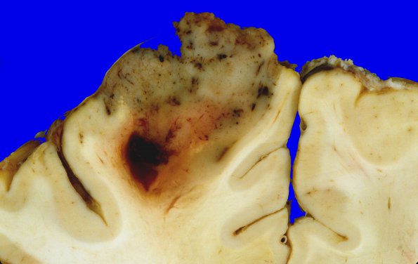 16A3 Glioblastoma (Case 16) 1