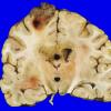 16A4 Glioblastoma (Case 16) 2