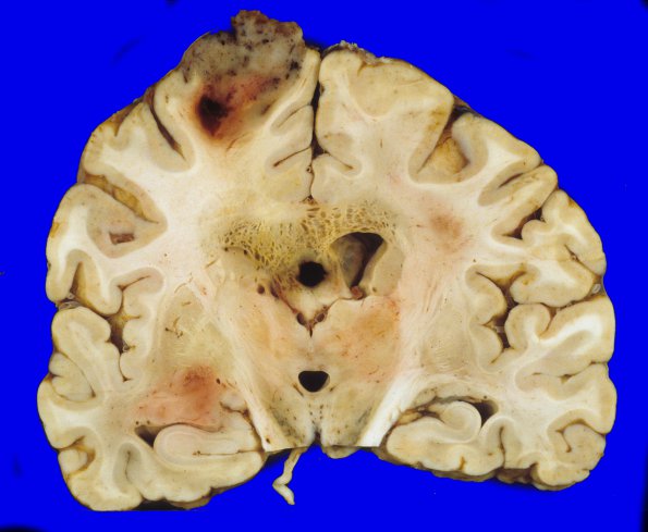 16A4 Glioblastoma (Case 16) 2