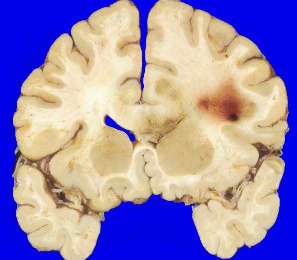 18A1 GBM (Case 18) 2