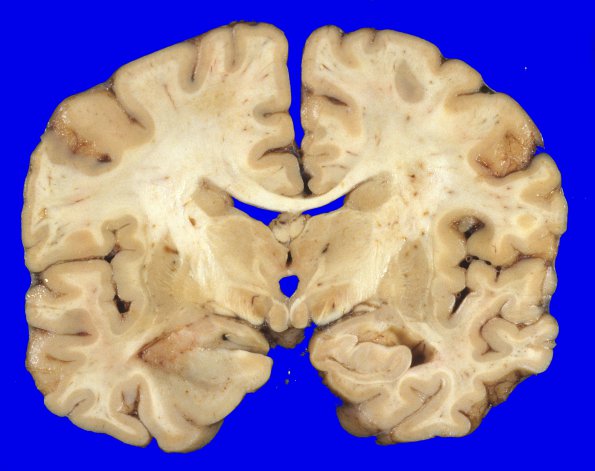 19A1 GBM (Case 19) 8