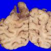 19A3 Glioblastoma (Case 19) 3