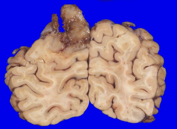 19A3 Glioblastoma (Case 19) 3