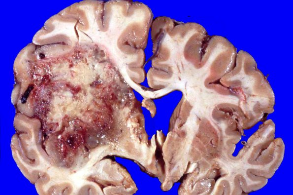 1A1 Glioblastoma (Case 1) no Rx 7