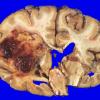 1A2 Glioblastoma (Case 1) no Rx 4