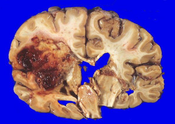 1A2 Glioblastoma (Case 1) no Rx 4