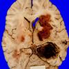 20A1 Glioblastoma (Case 20) 1