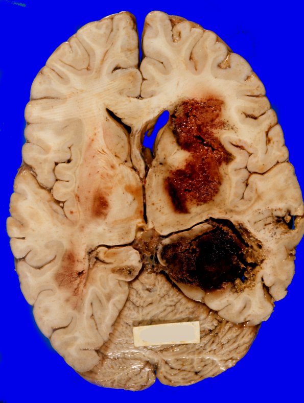 20A1 Glioblastoma (Case 20) 1