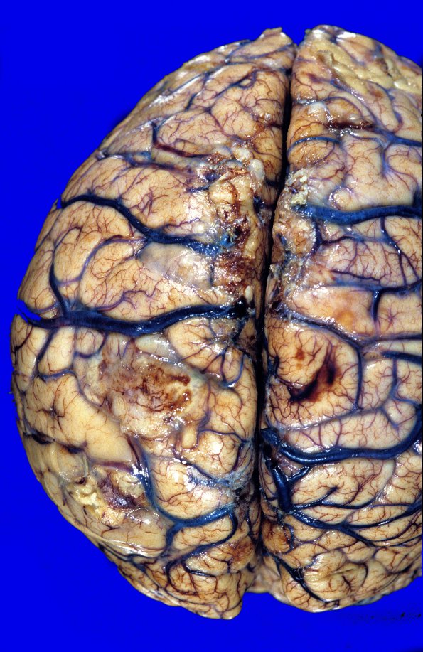 21A1 Glioblastoma (Case 21) 2