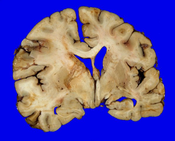 21A3 GBM (Case 21) 1