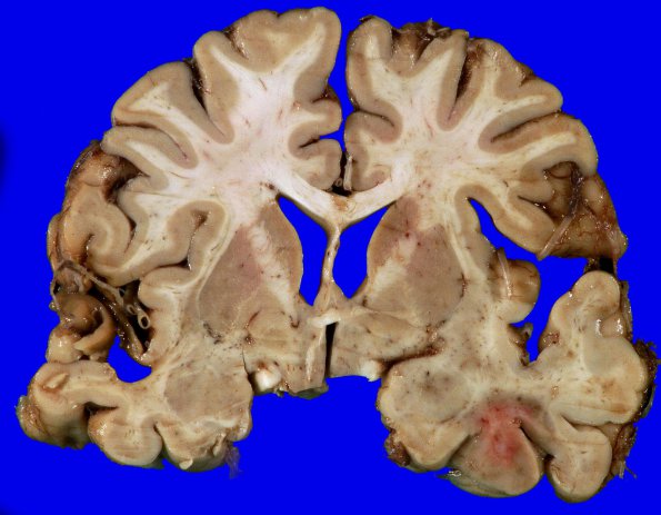 23A1 GBM, unsuspected, bilat (Case 23) H&E _2