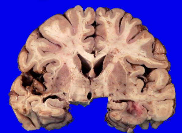 23A2 GBM, unsuspected, bilat (Case 23) H&E _3