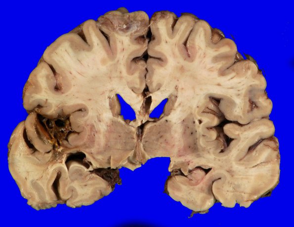 23A3 GBM, unsuspected, bilat (Case 23 H&E _4