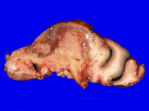 24A1 GBM (Case 24) Match with H&E