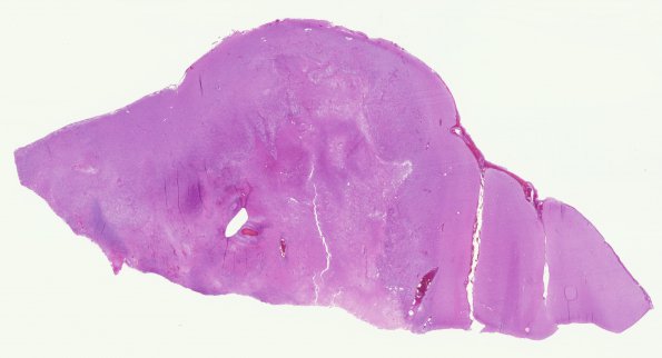 24A2 GBM (Case 24) Match with Gross H&E